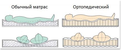 Сравните положения тела на обычном и ортопедическом матрасе.